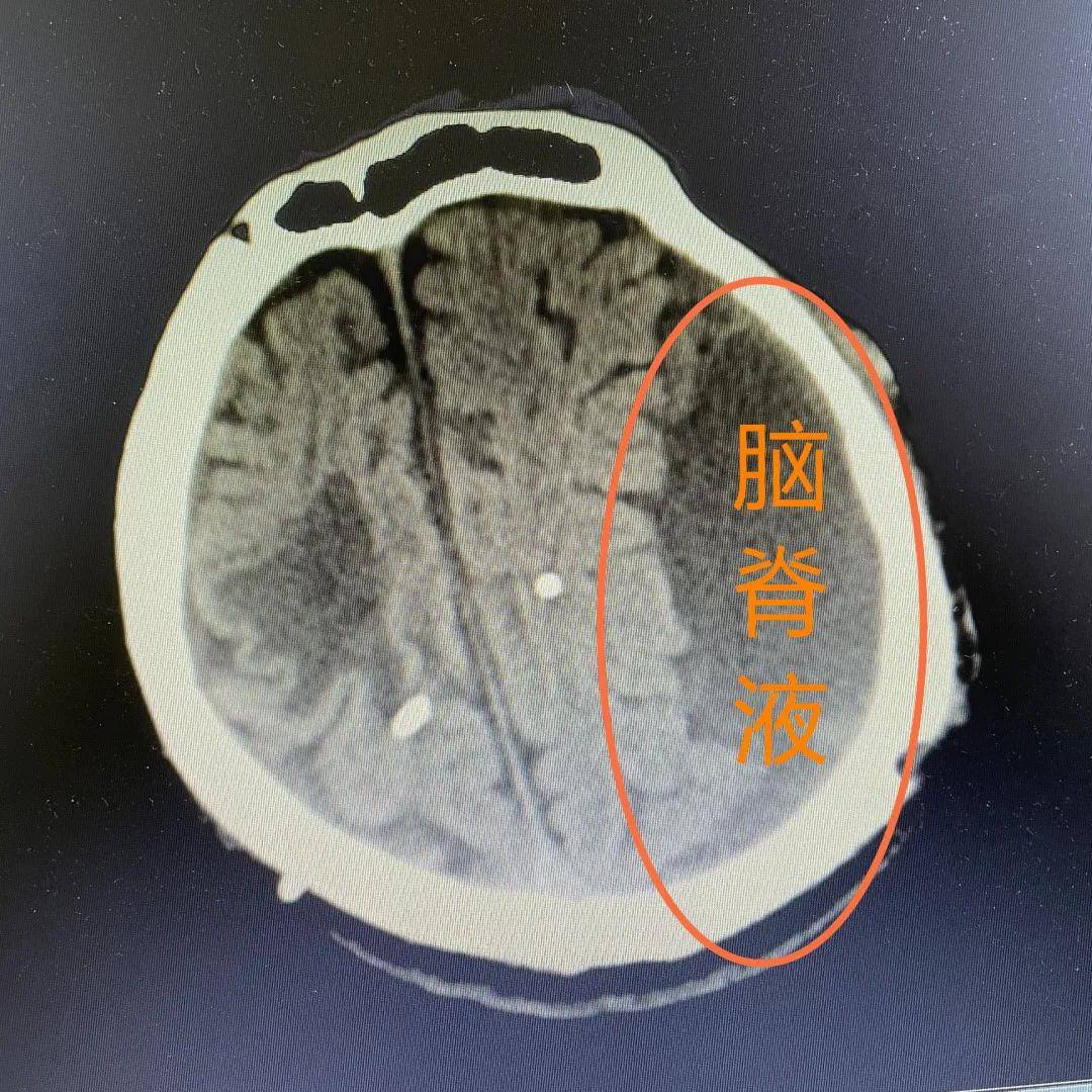 先行拔除左侧脑室-腹腔分流术 脑室ommaya囊外引流术,再给其行右侧