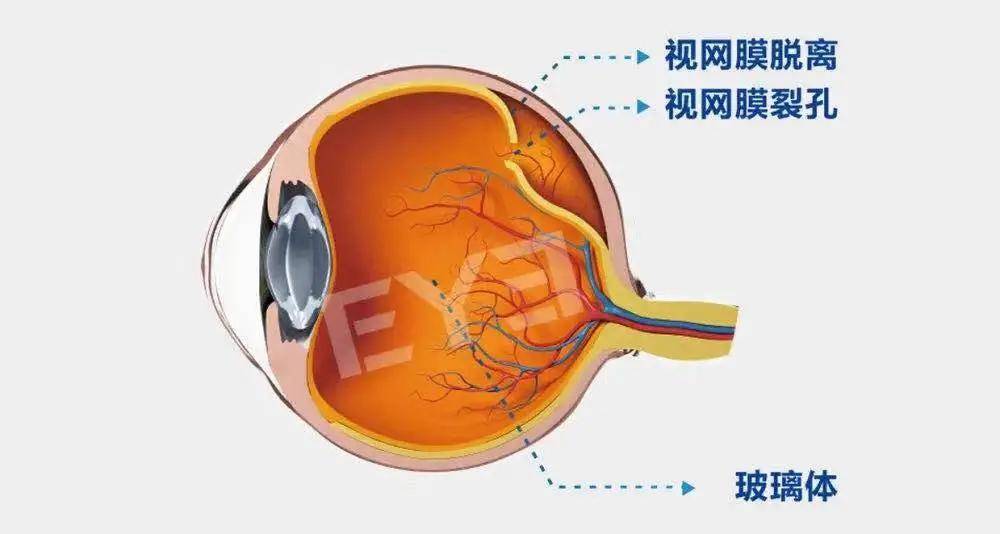 高度近视小心视网膜脱离!