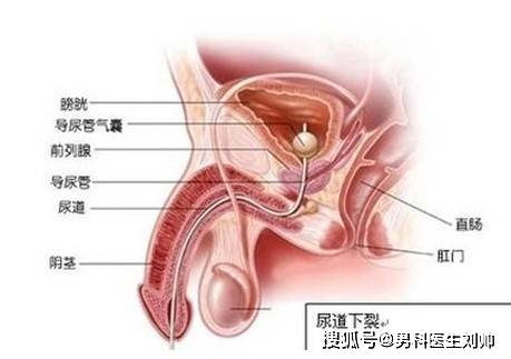 男性生殖系统损伤:尿道损伤