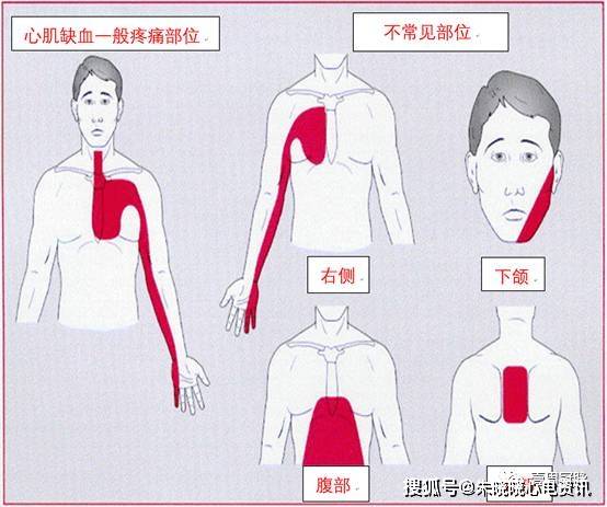 冠心病心绞痛心梗是什么