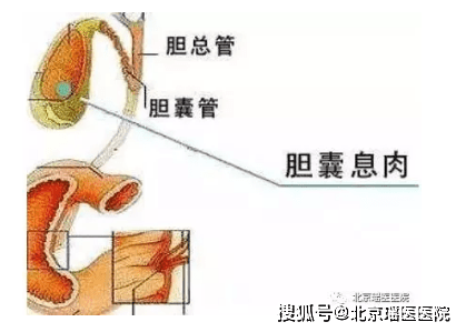 胆囊息肉已成为现代都市人健康的一大杀手