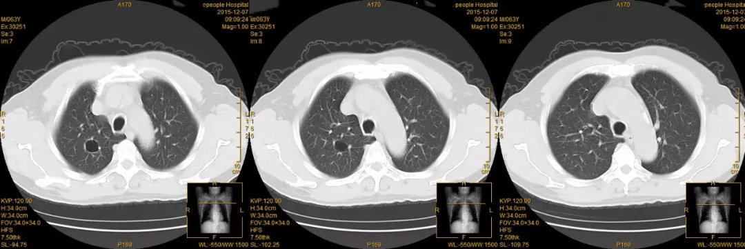 此次胸部 ct 发现右肺上叶可见一空腔,边界清晰,未见明显的磨玻璃影