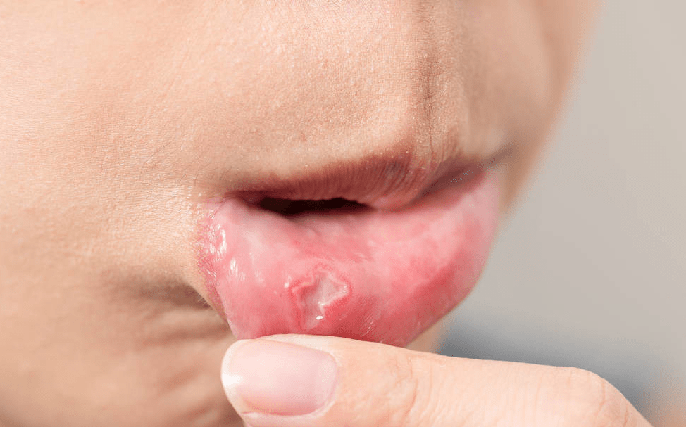 口腔癌早期有什么症状?出现3个信号,就需要提防了