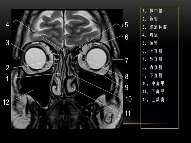 mri下眼部及鼻窦解剖图谱
