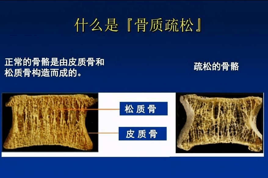 骨质疏松症是由于多种原因导致的骨密度和骨质量下降,骨微结构破坏