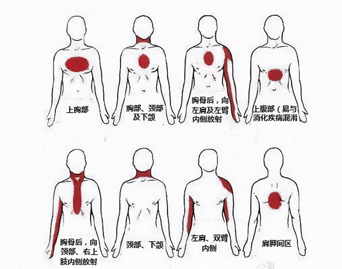 二,心肌梗死都有哪些表现其实刘先生后背疼痛就是心肌梗死的预兆,可是