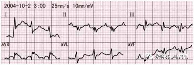 急性肺栓塞的诊断利剑心电图