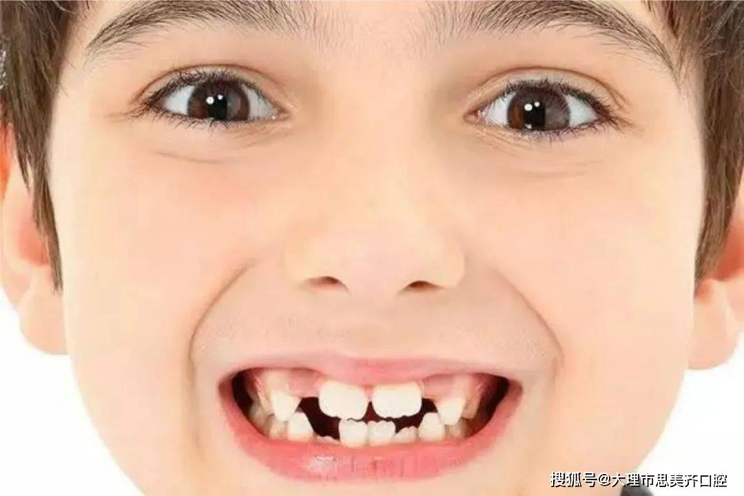 换完牙后,孩子的门牙竟成了"大板牙"!