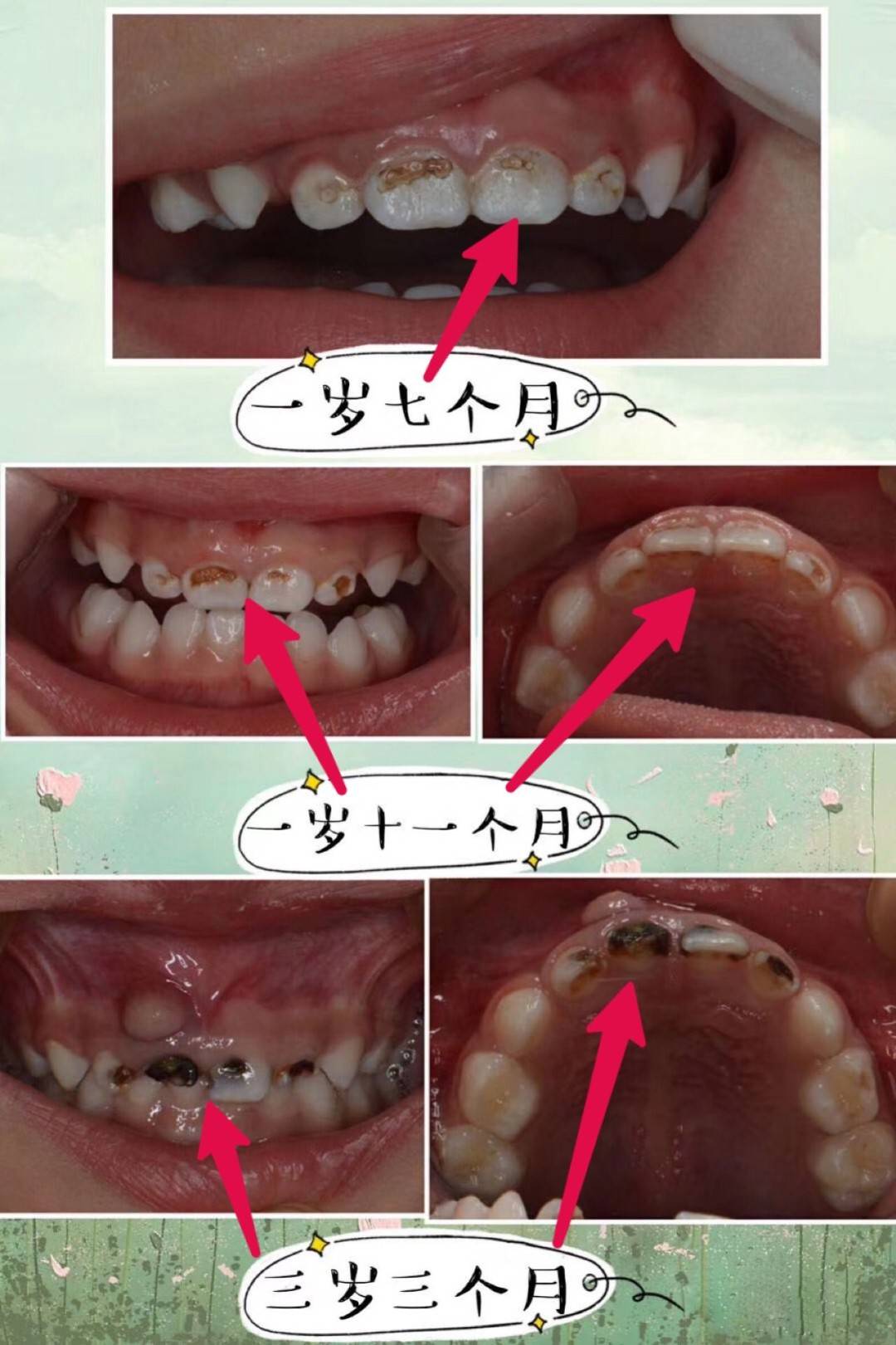 之所以不能补牙有三方面: 第一方面是:蛀牙出现疼痛,说明牙髓受细菌