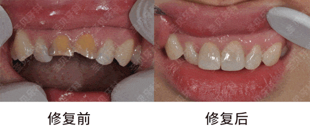 广州圣贝蔡菁菁医生带你了解牙齿修复那些事儿!