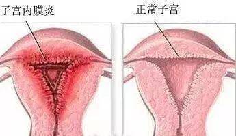 子宫内膜薄的女性月经经期时间会不固定,来月经后,经量经量较少,颜色