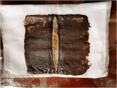 综合运用中医小针刀,中药封包,针灸推拿,中药熏蒸等特色诊疗技术,治疗