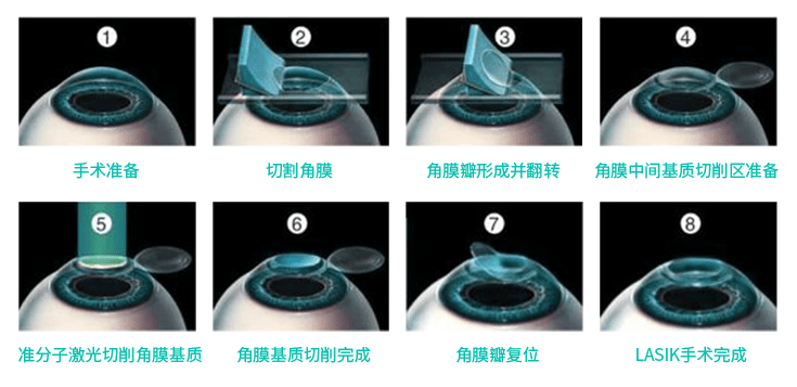 lasik近视手术过程