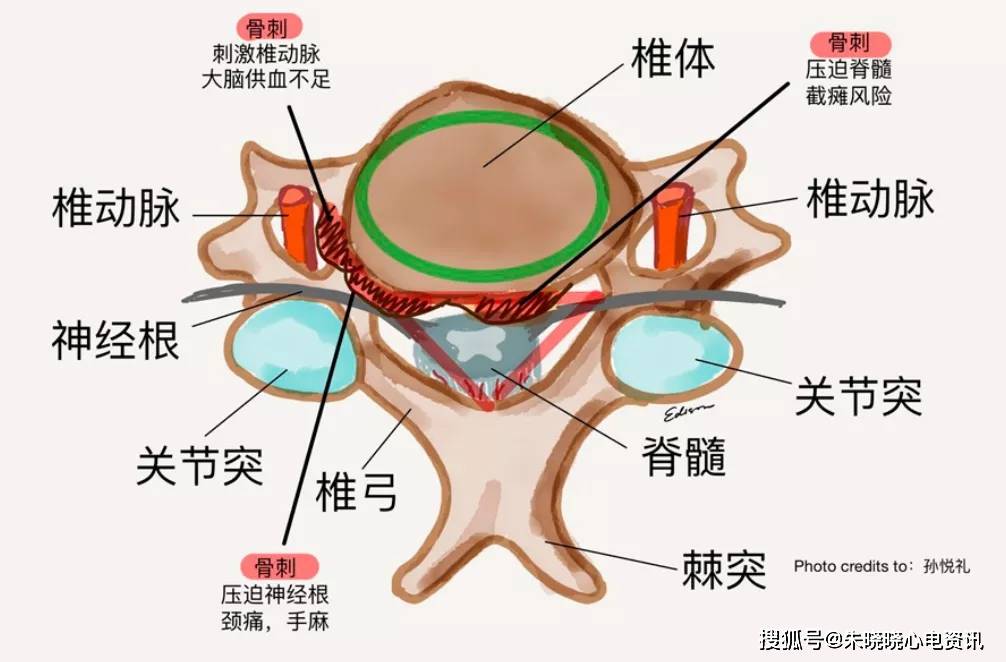 「骨刺」最易缠上6类人,做好两件事"拔"出这颗刺