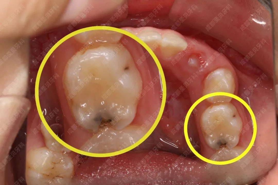 一个牙菌斑的自述:我是如何毁坏牙齿的.