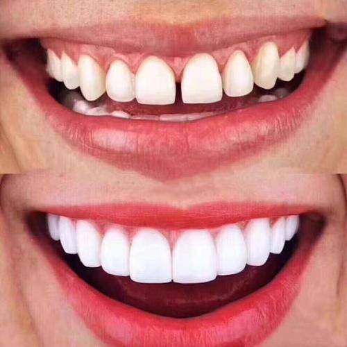 如果牙齿有缺损做牙齿贴面会好些吗