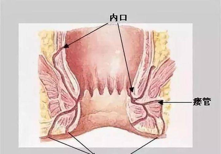 肛瘘——比痔疮的危害更大