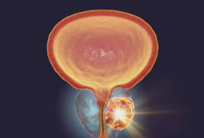 通常没有任何症状,随着肿瘤的发展,可能会产生类似前列腺增生类似的