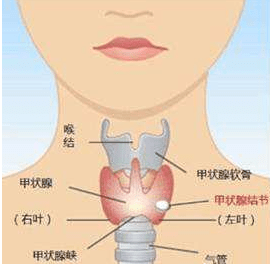 你所关心的甲状腺结节常见问题都