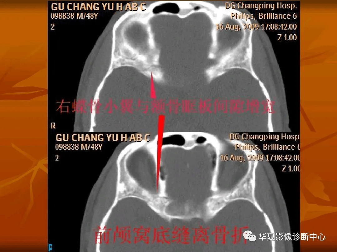 颅底ct高清图解 常见骨折部位图示