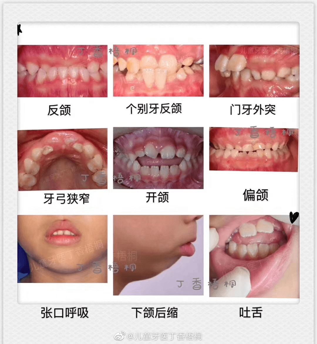 儿童早期牙齿矫正真的有这么重要吗?