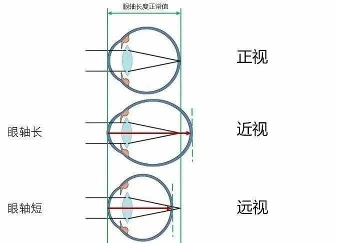 嗨视力近视科普15岁以下的青少年为什么要检查眼轴呢