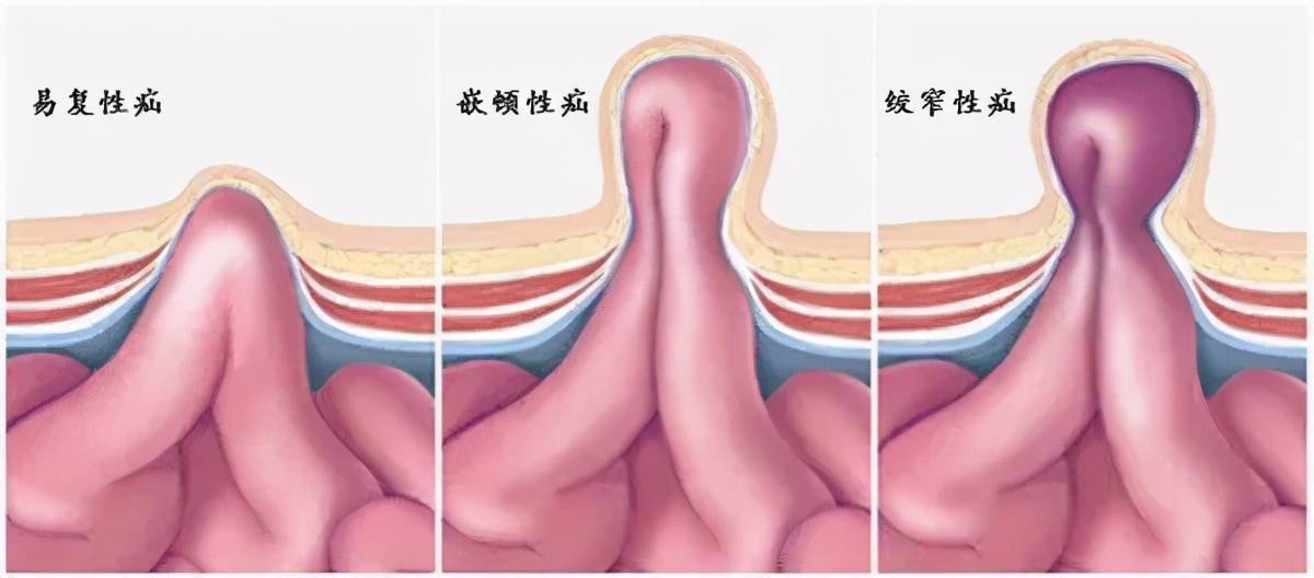 高龄老人腹股沟疝痛苦大局麻下无张力修补解顽疾