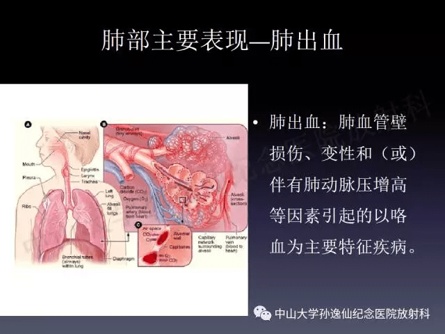 肺出血的影像学特征