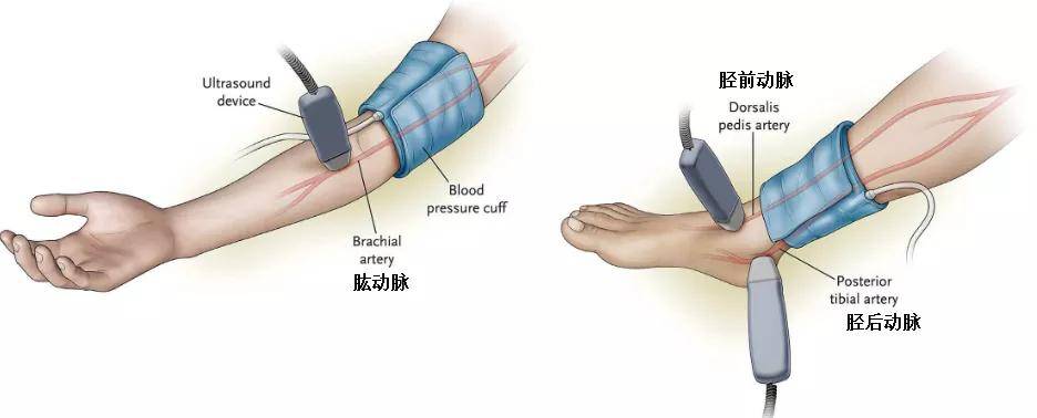 老人腿麻,怕冷,谨防下肢动脉硬化闭塞症!——深圳二院