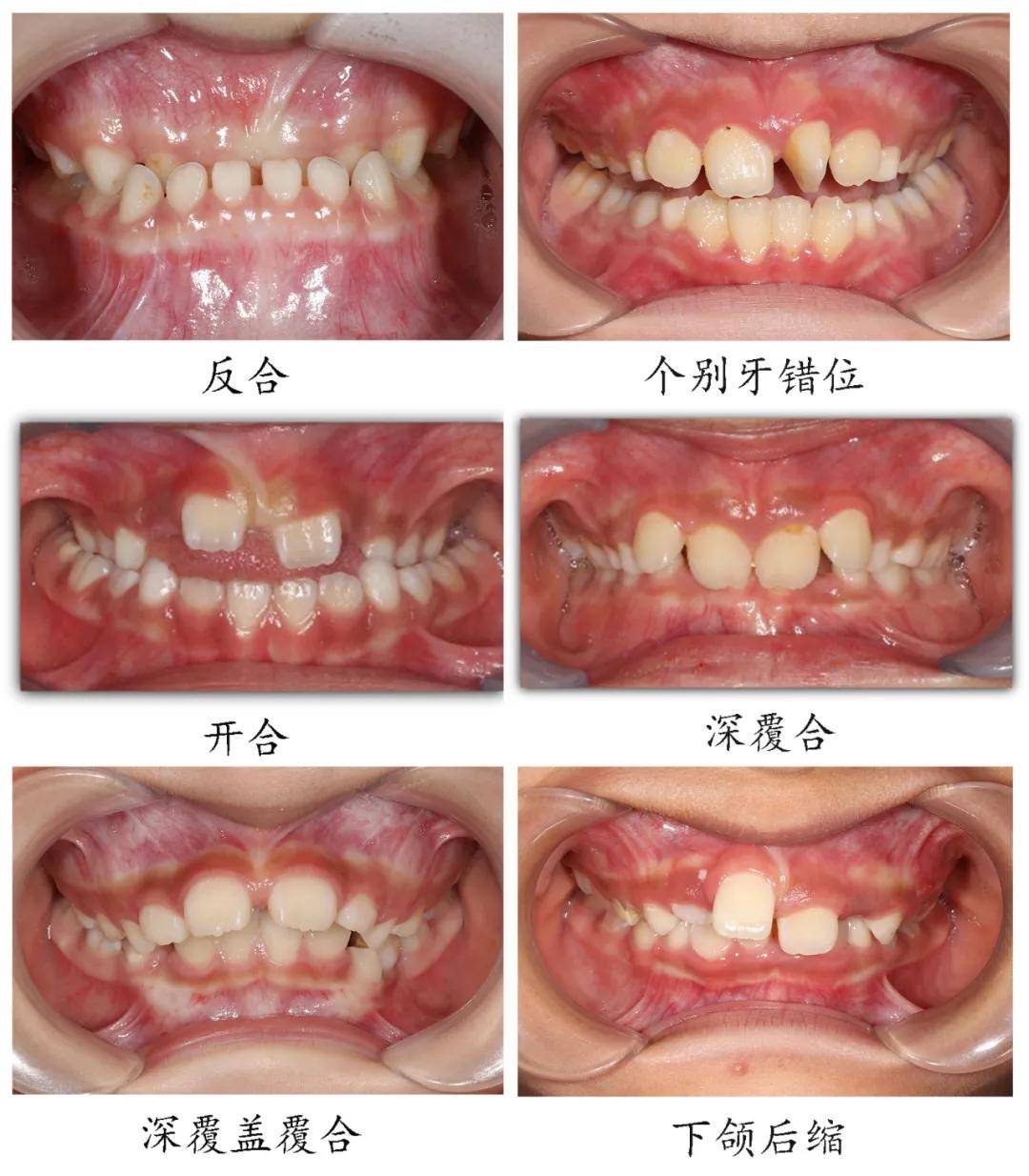儿童换牙期间需要注意哪些口腔问题?_畸形