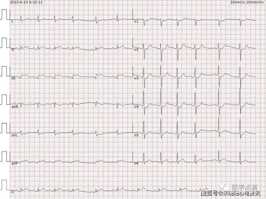 心电图"零"基础入门,干货满满!