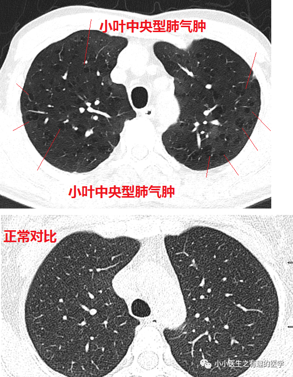 ct经典图谱:肺气肿ct典型图谱,一学就会