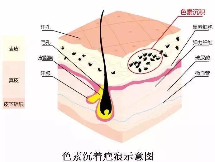上海健桥医院皮肤科胥肖琴:手术疤痕的分类及危害!