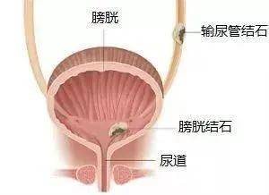 康乃馨医院成功实施经尿道输尿管镜下钬激光联合气压弹道碎石取石术