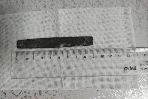 整个取物过程不到20分钟,一根长度9cm左右的金属条成功从患者胃内取出
