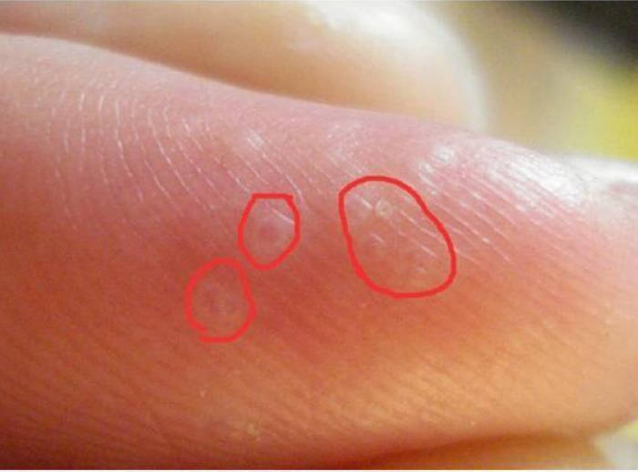 误以为是皮肤过敏,结果查出汗疱疹,手上有这种"小水泡