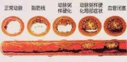 血管堵塞会有哪些症状?医生提醒:这些症状,可别忽视!