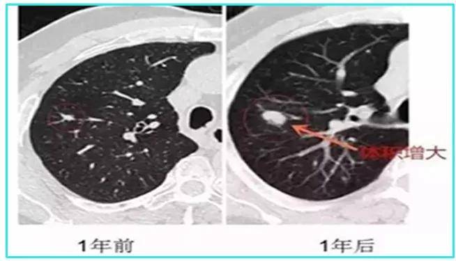 肺结节都会癌变,发现了就应该切除?错!