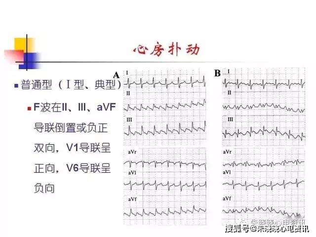 房速与房扑相关的心电问题