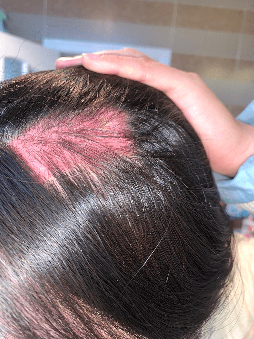 初诊时,我通过详细的问诊,总结x小姐具有以下这些症状:头皮处发红