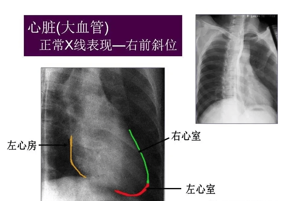 心脏(大血管)影像解剖