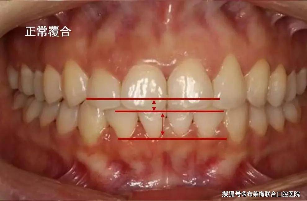深覆合是上前牙盖过下前牙牙冠长度1/3以上或下前牙咬合于上前牙舌侧1