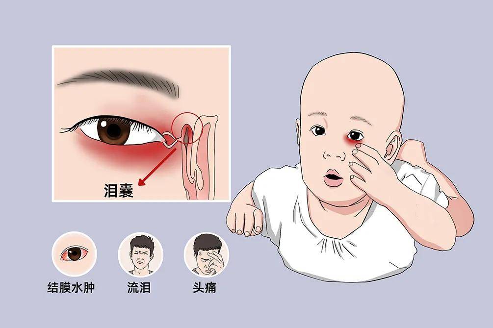 用手指挤压泪囊部时,可有多量粘液或脓液从泪小点返流到结膜囊内.