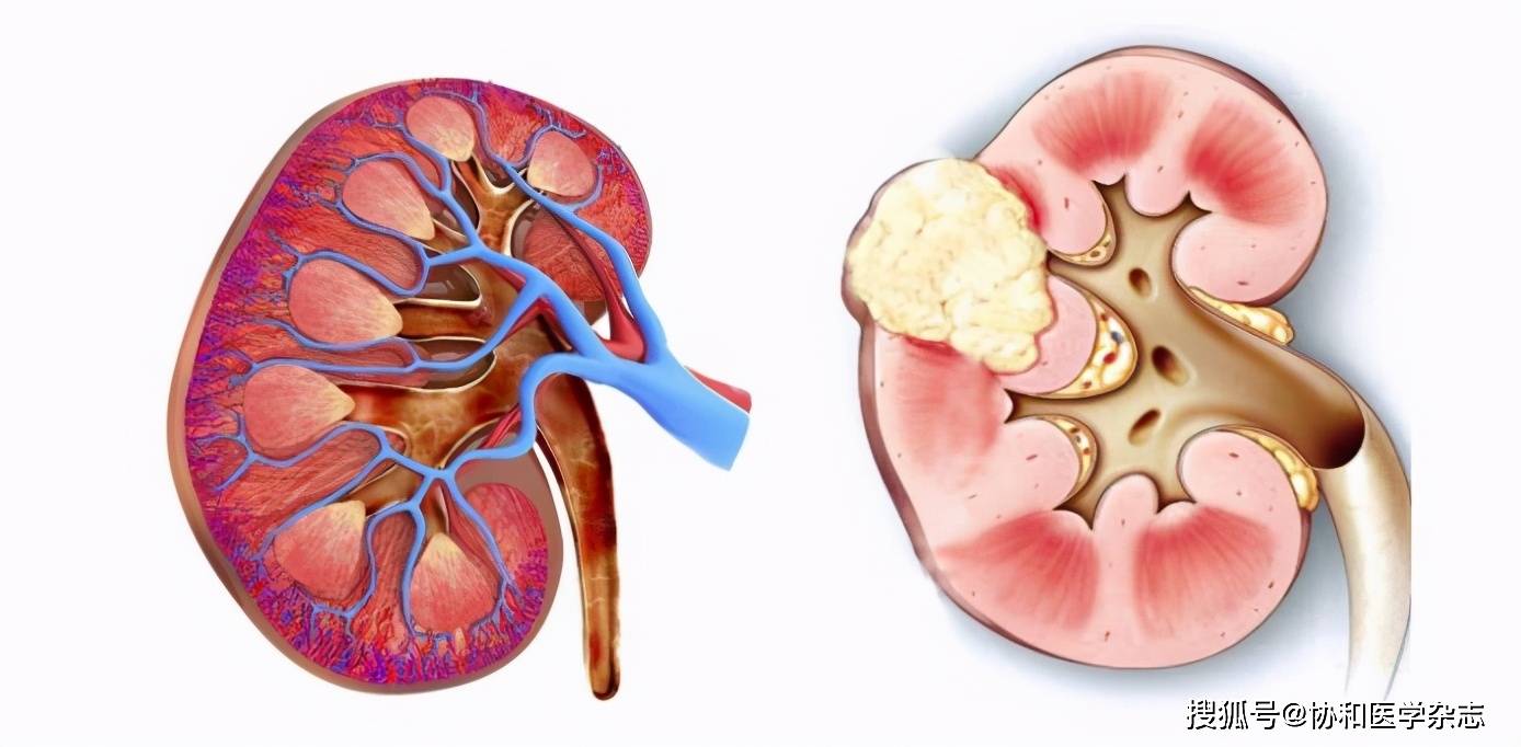 左正常肾脏,右肾癌剖面图