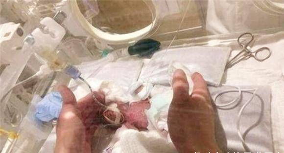 原创现实版拇指姑娘出生只有25厘米打破世界纪录如今怎样