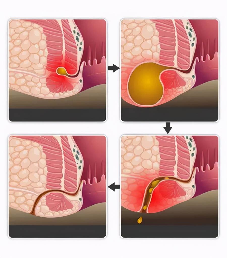 大部分肛瘘患者会出现流脓的现象,这属于特别重要的症状,导致脓液
