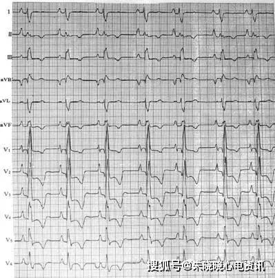 第四章 房室肥大心电图诊断_心室