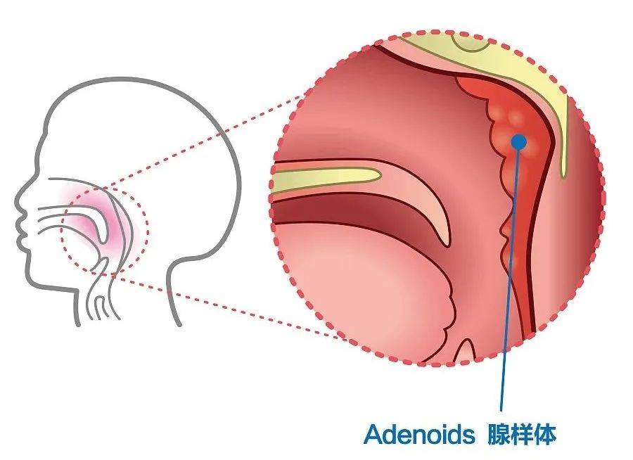 鼻塞等问题,要想到可能不仅仅是耳朵或鼻子的病,还要检查是否有腺样体