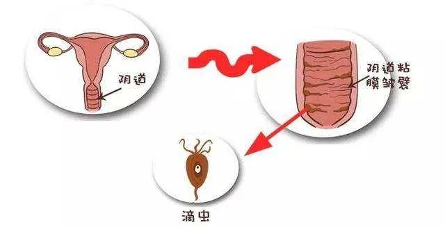 教你区分女性的7种阴道炎 ——功立欣妇科