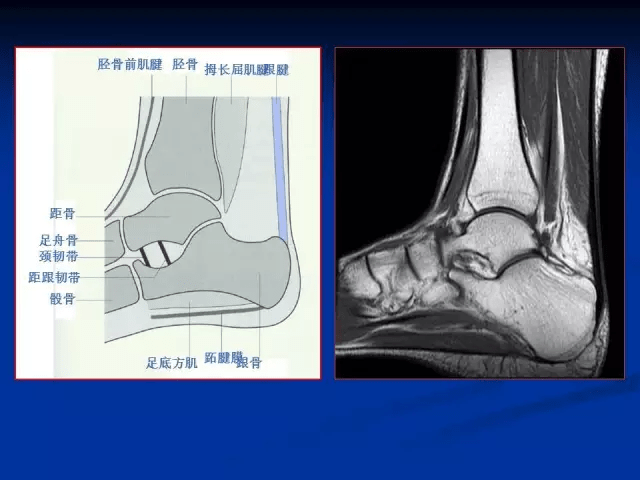 踝关节mri读片要点